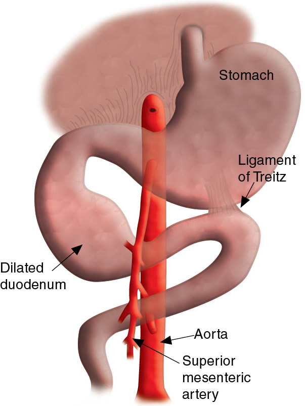 semaglutide gi bleed Upper GI Bleeds semaglutide gi bleed Upper GI Bleeds